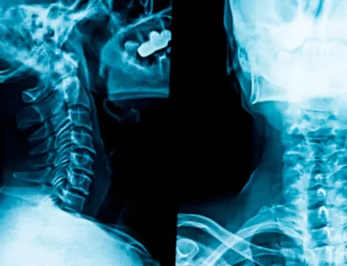 “Understanding Neck X-Ray: What You Need to Know”