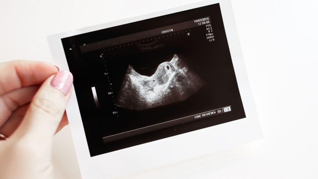 Ultrasound Photos